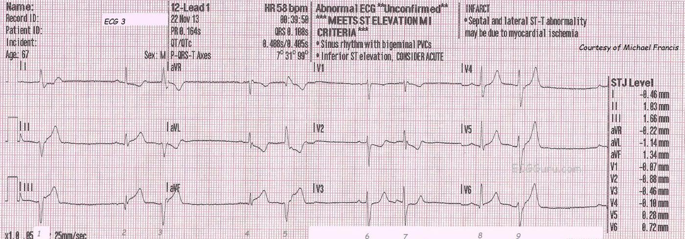 Teaching Series 112213 Inferior Posterior Wall M I With Right